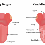 Candidiasis oral: causas, síntomas, diagnóstico, tratamiento y prevención