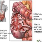 Enteritis: inflamación del intestino delgado
