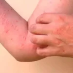 Chikungunya: explicación completa