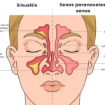 Sinusitis crónica: inflamación persistente de los senos paranasales