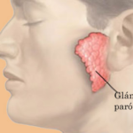 Parotiditis (Paperas)