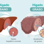 Hígado graso no alcohólico: causas, síntomas y tratamiento