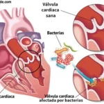 Endocarditis infecciosa