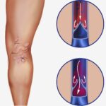 Insuficiencia venosa crónica