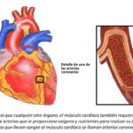 Cardiopatía isquémica