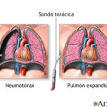 Neumotórax
