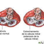 Estenosis mitral