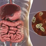 Giardiasis: explicación completa