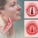 Laringitis: causas, síntomas y tratamiento