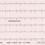 Flutter auricular: causas, síntomas y tratamiento