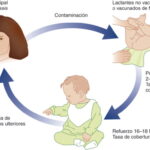 Coqueluche (Tos ferina)