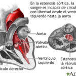 Estenosis Aórtica: Definición, Causas, Síntomas y Tratamiento