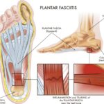 Fascitis plantar: dolor en el talón que no debes ignorar