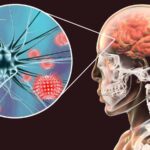 Meningitis bacteriana