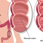 Colitis ulcerosa: una enfermedad inflamatoria crónica del intestino