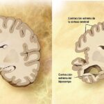 Enfermedad de Alzheimer: deterioro progresivo de la memoria y la cognición
