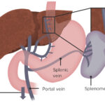 Hipertensión Portal: Explicación Completa