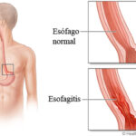 Esofagitis: Explicación Completa