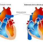 Estenosis pulmonar