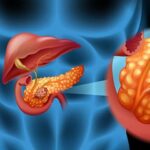 Pancreatitis crónica