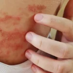Dermatitis atópica