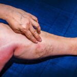 Tromboflebitis: inflamación y coágulos en las venas