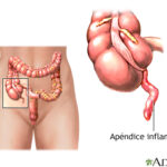 Apendicitis: una urgencia abdominal común