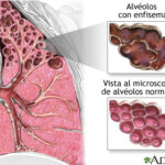 Enfermedad Pulmonar Obstructiva Crónica (EPOC)