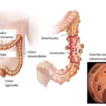 Diverticulitis