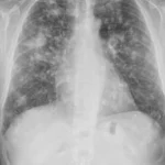Aspergilosis pulmonar: explicación completa