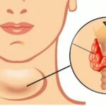 Hipotiroidismo: explicación completa