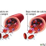 Hipocalcemia: causas, síntomas, diagnóstico y tratamiento