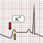 Hipopotasemia: causas, síntomas, diagnóstico y tratamiento