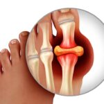 Hiperuricemia: causas, síntomas y riesgos para la salud