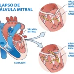 Prolapso de la Válvula Mitral