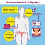 Síndrome de ovario poliquístico