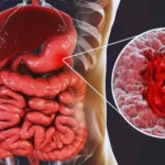 Cáncer Gástrico: Una Enfermedad que Requiere Detección Temprana