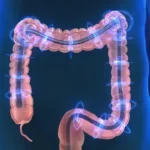Colitis microscópica: enfermedad inflamatoria del colon de difícil detección