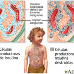 Diabetes tipo 1: enfermedad autoinmune crónica que requiere control de por vida