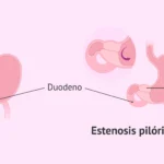 Estenosis pilórica: causas, síntomas, diagnóstico y tratamiento