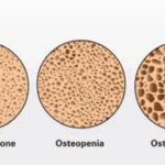Osteopenia: disminución de la densidad ósea y su importancia en la salud