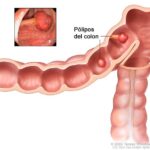 Poliposis intestinal: causas, manifestaciones y manejo integral