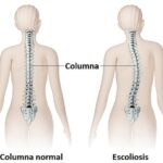 Escoliosis: una alteración en la curvatura de la columna vertebral