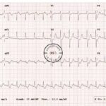 Taquicardia Supraventricular