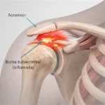 Bursitis