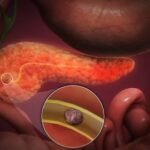 Pancreatitis Aguda