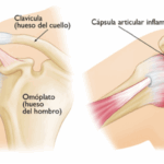 Capsulitis Adhesiva