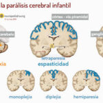 Parálisis Cerebral
