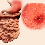 Gastritis Erosiva: una enfermedad que puede dañar el revestimiento del estómago
