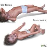 Convulsiones Febriles: qué son y cómo actuar
